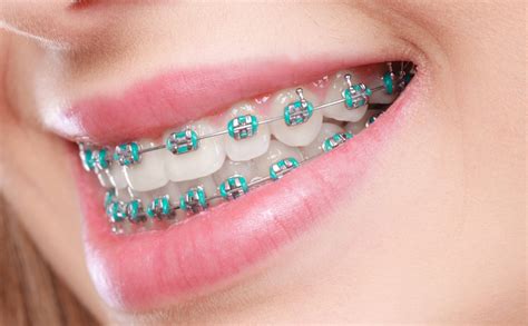 does maxicare cover dental braces|Welcome to GetSimple! .